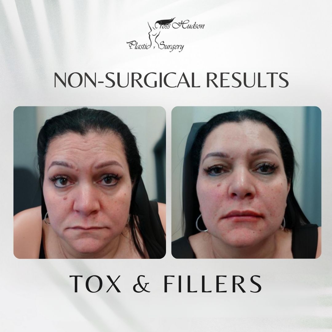 Before and after comparison showing cheek filler results with improved facial volume and definition